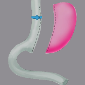 Banded-gastric-sleeve