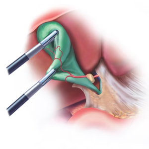 Laparoscopic Cholecystectomy