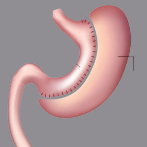 Laparoscopic_Gastric_Sleeve_surgery