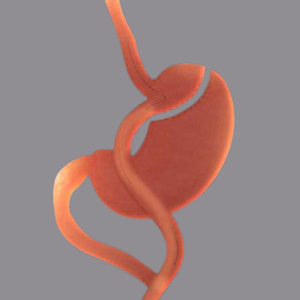 laproscopic gastric bypass surgery