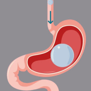 بالون المعدة